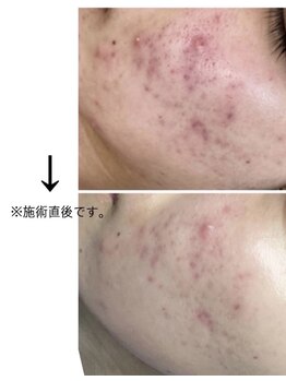 ヴィノ アイサロン(VINNO eyesalon)/ハーブピーリングでニキビ改善☆
