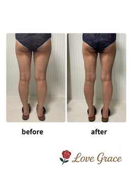 ラブグレイス(Lovegrace)/before/after