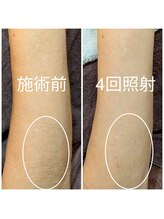 エミナル(EMINAL)/～肘下の脱毛の効果～女性　