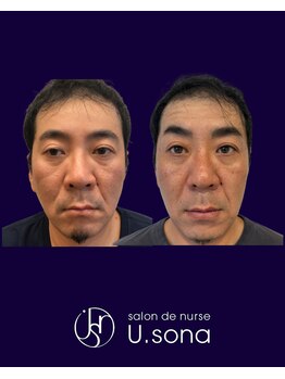 小顔・脂肪コントロール専門 salon de nurse U.sona～松本店～/【韓国基礎化粧品で男性も激変】