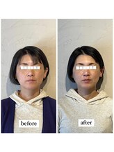 マーマー(murmur.)/小顔矯正 before / after