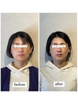マーマー(murmur.)/小顔矯正 before / after