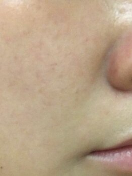 リヴェルテ(LIVERTE)の写真/毛穴の黒ずみ/開き/ざらつきにお悩みの方必見!話題のREVIハーブピーリングで毛穴レスのうる艶美肌に!