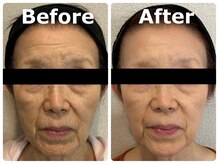 スイ 昭島店(Sui)/超音波＋ハーブピーリング