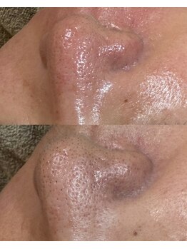 モンクラッシー(Mon classy)/鼻の毛穴改善