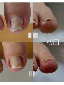 おん/巻き爪補正経過2-右(20代女性)