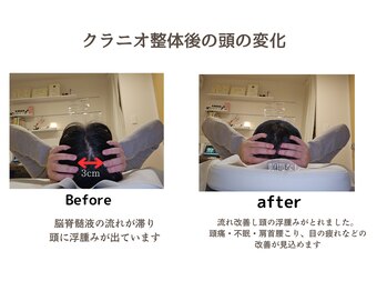 しろねこ整体院/クラニオ整体後の頭の変化