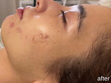 サロン ド エメ(salon de aimer)/【After】一気に赤みが鎮静♪