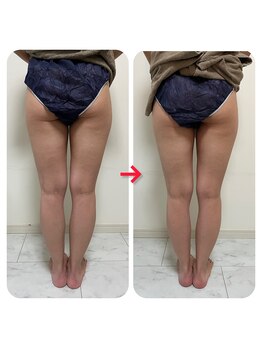 ルクール(Le Couer)/痩身【美尻美脚コース】