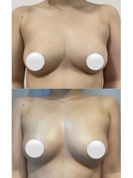 メディカルエース(MedicalAce)/柔らかバスト！