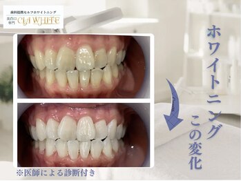 シアホワイト(CIA WHITE)/劇的ビフォーアフター