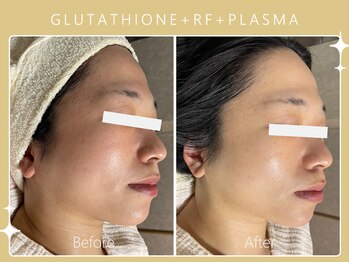 ハノハノ 八代店(HANO HANO)/グルタチオン+RF+プラズマ☆