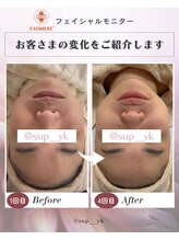 ノヴェル(Novelle)/肌悩み解決！