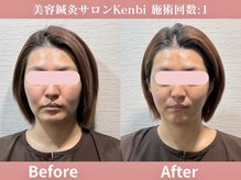 ケンビ(Kenbi)の雰囲気（美容鍼×整体・美容鍼×小顔矯正だからこその即効性＆持続性♪）