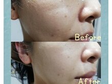 RiとBiのたまご/(フェイシャル）　美肌