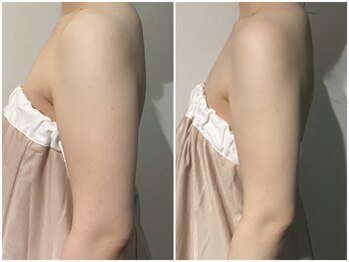 OBS新潟整骨院/脂肪冷却ビフォーアフター！