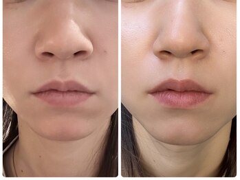 オーラ(AURA)/小顔だけじゃない美肌も一緒に