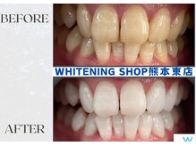 ホワイトニングショップ熊本東店/ホワイトニングショップ熊本東店