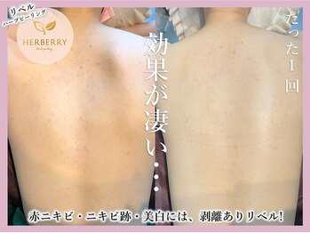 アッシュ 梅田(H)/ハーブピーリング専門Hアッシュ