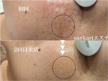 サンカリビューティー(SANKARI beauty)の雰囲気（40代からのシミくすみケア！いつからだって今日が始め時です♪）
