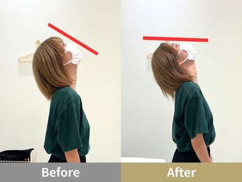 せなかのはね 井尻店/20代女性　首こり　猫背　肩こり