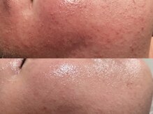 バタフライ 津田沼店(Butterfly)/Butterflyのハーブピーリング