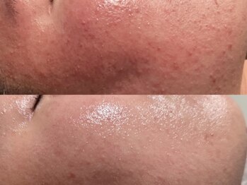 バタフライ 津田沼店(Butterfly)/Butterflyのハーブピーリング