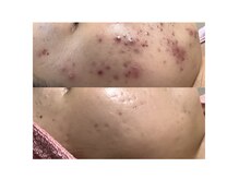 ピュリフィケーション(Purification)の雰囲気（なかなか改善しない肌荒れは次世代バイオピ－リングでOK♪）