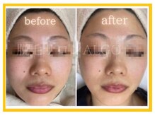 アルゴ 太田店(ALGO)/毛穴洗浄+光フォト+幹細胞導入