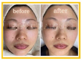 アルゴ 太田店(ALGO)/毛穴洗浄+光フォト+幹細胞導入