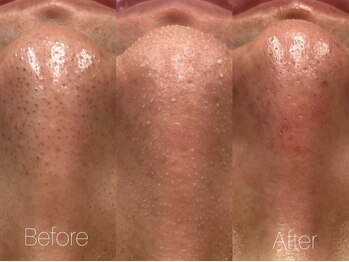 ビヨンド リンク(BEYOND L'INK)/韓国式3D毛穴洗浄