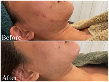 サロンドフェイス(Salon de Faith)/【ハーブピーリング】10回施術♪