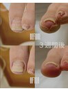 巻き爪補正経過2-左(20代女性)