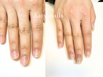 アーティネイルズ(Aaty Nails)/【深爪矯正】ハンド