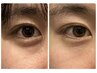 【モニター募集中】目元のたるみ特化の美容鍼灸￥12100→￥8800
