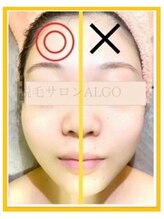 アルゴ 太田店(ALGO)/ 小顔脱毛