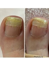 リゼラアンドコー 宇都宮店/巻き爪矯正♪B/Sスパンゲ