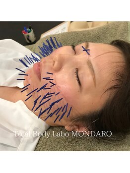 モンダロ(MONDARO)/美容鍼