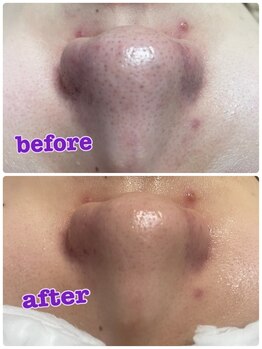 サンテ(Sante)/ハイドラフェイシャル