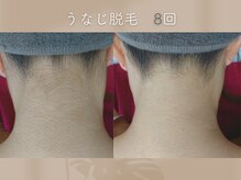 ミシェリ(MCHERI)/うなじ脱毛