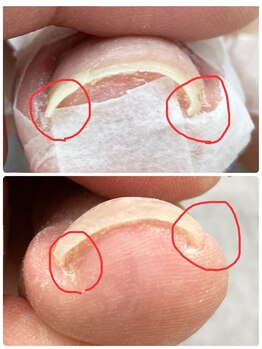 爪処 中野坂上/巻き爪ケア