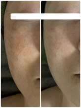 ビジュープラス 幸手店(Bijou+)/美白・シミケア