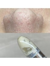 ビューティ サロン ココ ア ドール(Coco a Doll)/イチゴ鼻卒業！韓国式3D毛穴洗浄