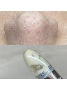 ビューティ サロン ココ ア ドール(Coco a Doll)/イチゴ鼻卒業!韓国式3D毛穴洗浄