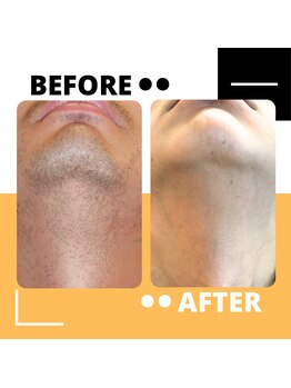 アルジェンヌ 五井店/メンズ脱毛 before/after