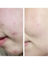 フェデネージュ(fee des neige)/ニキビケア