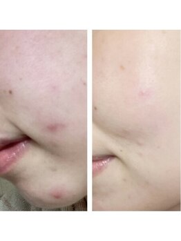 フェデネージュ(fee des neige)/ニキビケア