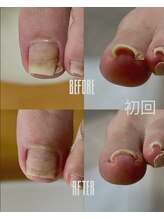 おん/巻き爪補正経過1-左(20代女性)