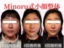 フレキシボディ(FlexiBody)/小顔施術ビフォーアフター #18