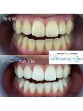 ホワイトニングサロン 熊本店/誰でもホワイトニング